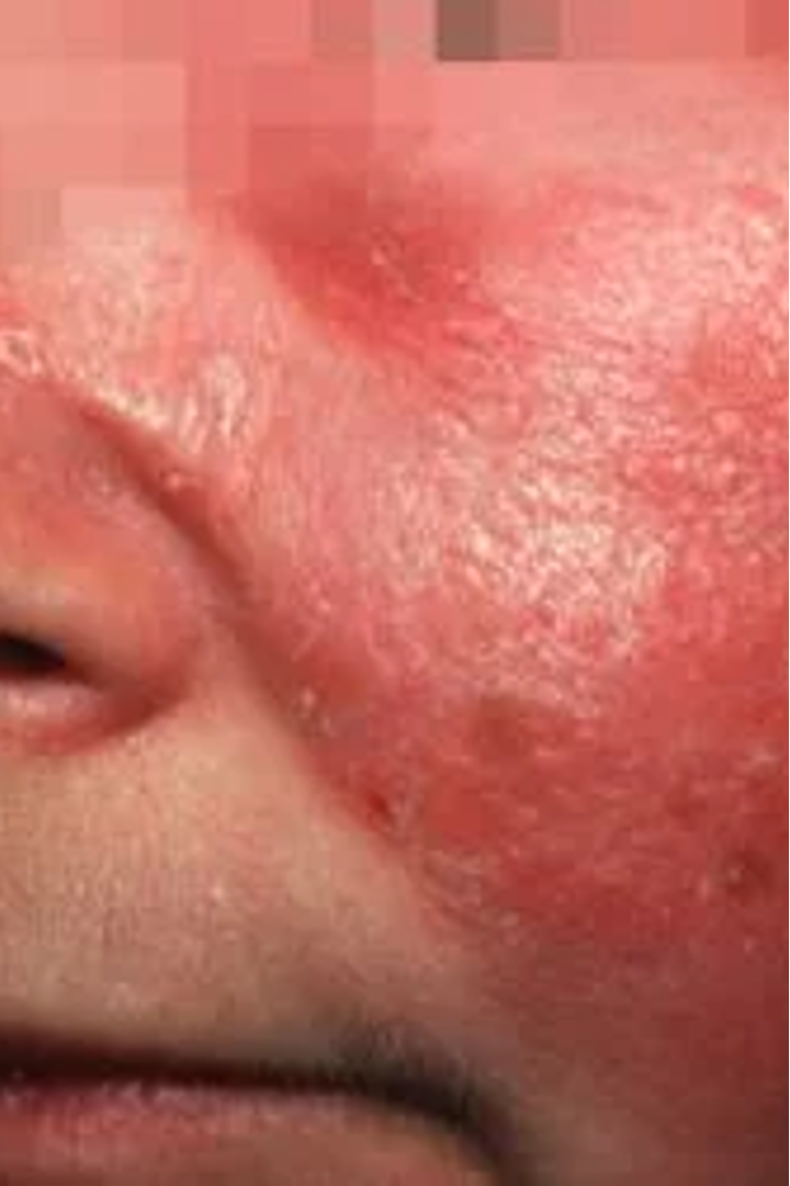 <p>painful, shiny, fiery bright red rash that is raised and well demarcated; non purulent; acute onset (mins-hrs); </p><p>most commonly on lower extremities, face will include nose and both cheeks most of the time</p>