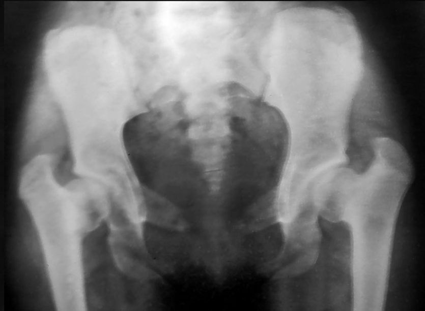 <p>what is seen here for this case of cleidocranial dysplasia?</p>