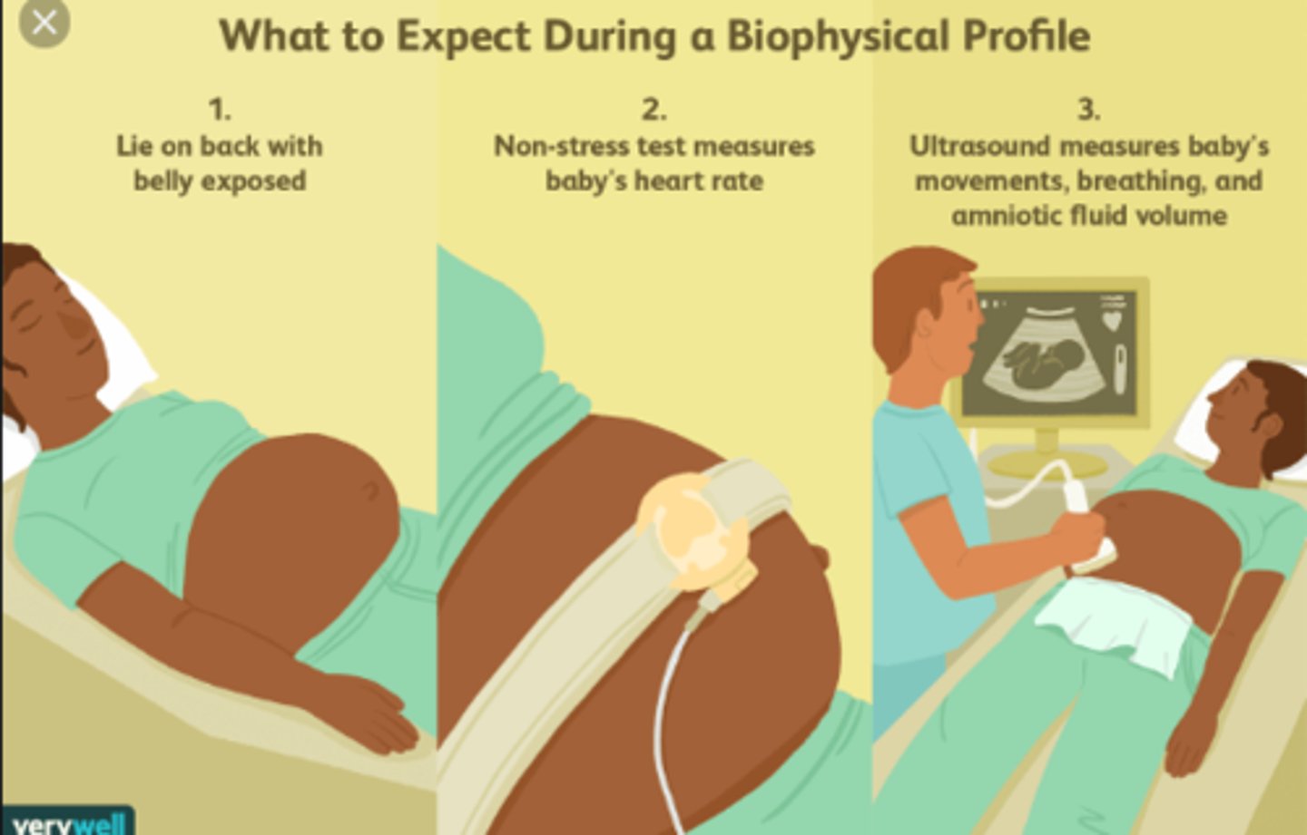 <p>Biophysical profile (BPP)</p><p>A biophysical profile (BPP) is a painless, noninvasive test that assesses the health of a fetus during pregnancy:</p><p>What it measures</p><p>A BPP measures the fetus's heart rate, breathing, movement, muscle tone, and the amount of amniotic fluid.</p><p>How it's performed</p><p>A BPP combines a nonstress test and an ultrasound. During the ultrasound, a gel is applied to the mother's belly to help sound waves pass through, and a handheld sensor is moved across the belly to create an image of the fetus.</p><p>When it's performed</p><p>A BPP is usually performed in the last trimester of pregnancy, but may be done earlier or more frequently for high-risk pregnancies.</p><p>How results are scored</p><p>The BPP results are a score out of 10 points based on the results of five measurements. A score of 8 or 10 indicates the fetus is healthy, 6 points may indicate a need for retesting, and 4 points or less may indicate problems.</p><p>A BPP may be recommended if the mother has certain conditions, such as high blood pressure, diabetes, or kidney disease. It may also be recommended if the pregnancy is past the due date, or if there are abnormal results on a nonstress test.</p><p>Biophysical Profile: BPP Ultrasound and Nonstress Test</p><p>What is a biophysical profile? A biophysical profile is a way to check on overall fetal health. It consists of two painless, nonin...</p><p>Johns Hopkins Medicine</p><p>Biophysical Profile (BPP) - Children's Hospital of Philadelphia</p><p>A biophysical profile (BPP) is a test that combines a nonstress test with ultrasound to check the health of the fetus. A nonstress...</p><p>Children's Hospital of Philadelphia</p><p>Biophysical Profile (BPP) Test - MyHealth Alberta</p><p>A biophysical profile (BPP) test measures the health of your baby (fetus) during pregnancy. A BPP test includes a fetal ultrasound...</p><p>MyHealth Alberta</p><p>Show all</p>