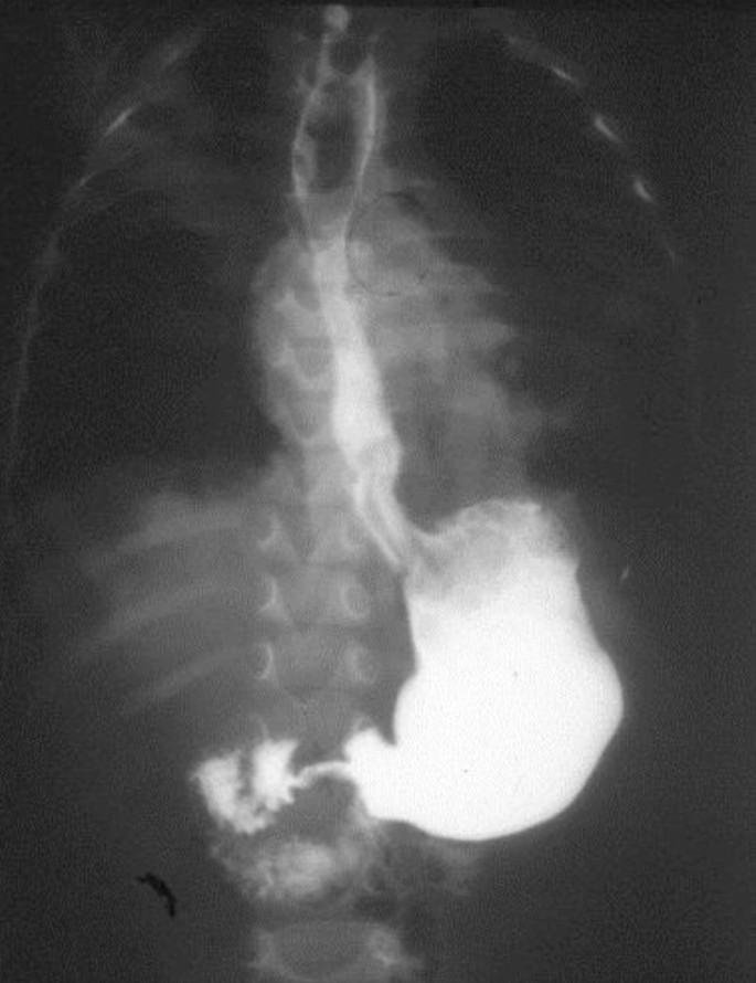 <p>What pathology is shown here?</p>