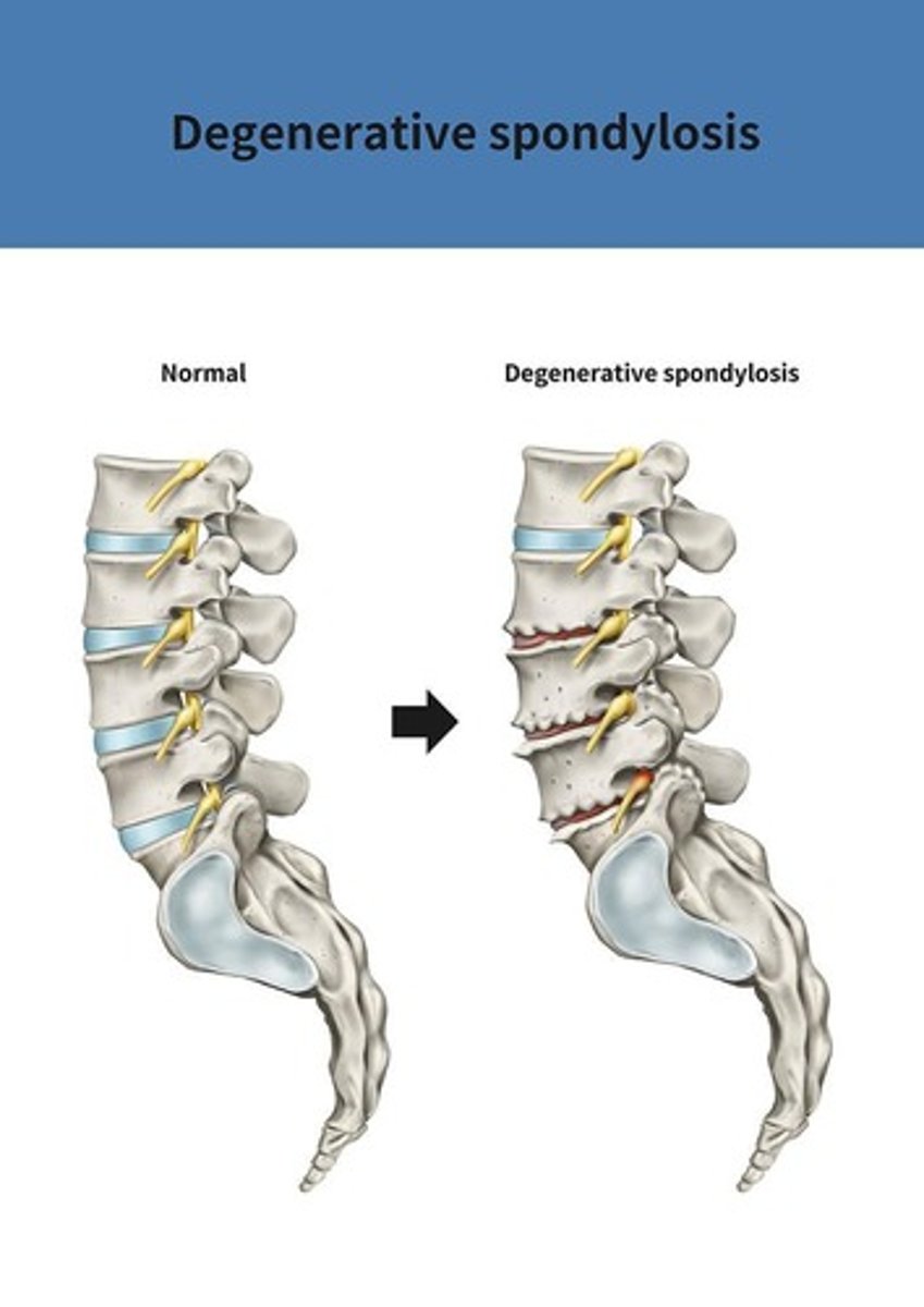 <p>A type of arthritis that involves the degeneration of joint cartilage.</p>