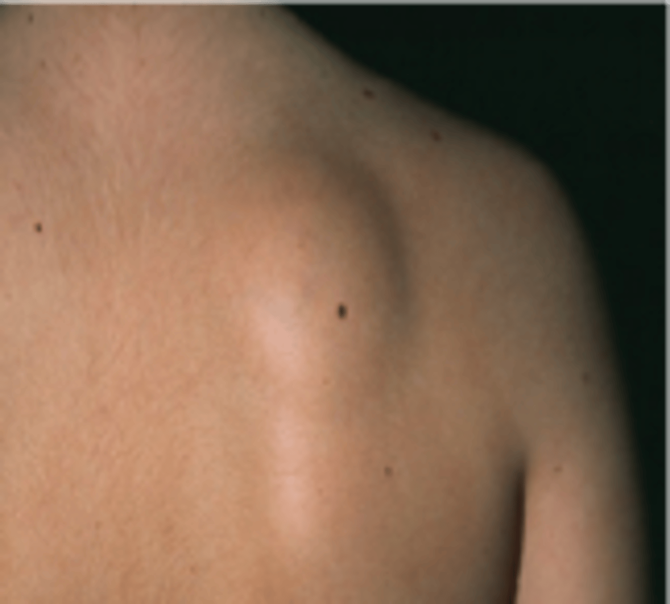 <p>•Solid, firm, rounded elevation of the skin, usually &gt; 1 cm</p><p>•Typically extends into deep skin layers</p><p>- Ex: Cyst, tumor, lipoma</p>