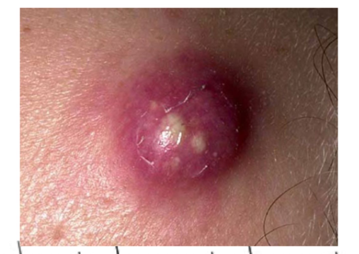 <p>a boil, abscess of a hair follicle</p>