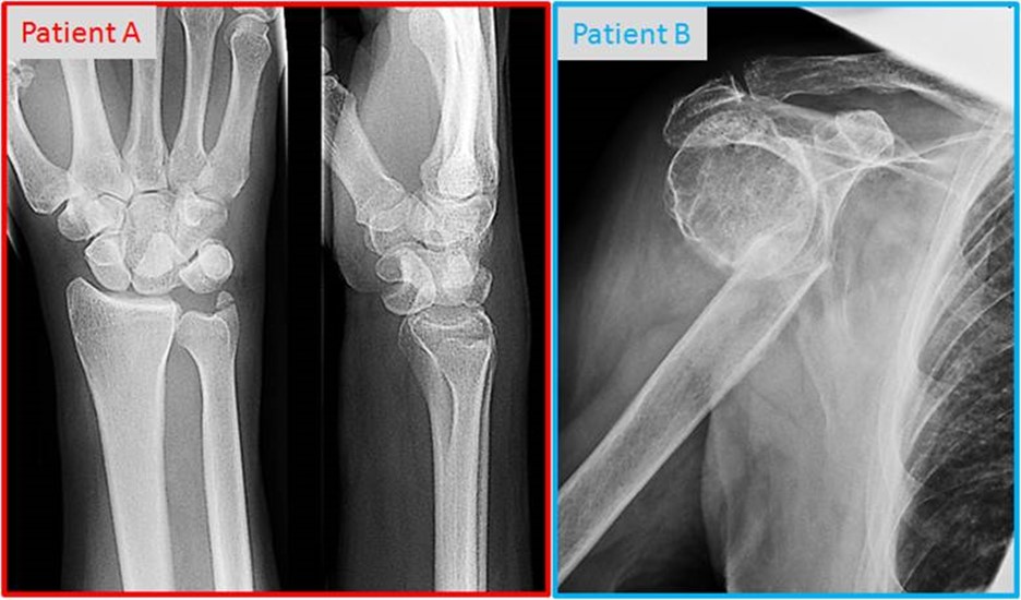 <p>Patient A: [see accompanying image- red] A 24-year-old male presents to the emergency room after a skateboarding accident with the chief complaint of wrist pain. A radiograph of his wrist reveals the accompanying image. What is the diagnosis?</p><p>A fractured ulnar styloid and:</p><p>A.) Avulsion fracture of the first metacarpal</p><p>B.) Dislocated lunate</p><p>C.) Fractured scaphoid</p><p>D.) Fractured capitate</p><p>E.) Fractured hamate</p><p></p><p>Patient B: [see accompanying image- blue] A 74-year-old female presents to the emergency room with shoulder pain after a falling down her basement stairs. Physical examination reveals a proximal arm deformity and sensory loss over the lateral aspect of her proximal arm. Radiographs reveal the accompanying image. What muscle is most likely paralyzed?</p><p>A.) Biceps brachii</p><p>B.) Pectoralis minor</p><p>C.) Serratus anterior</p><p>D.) Subscapularis</p><p>E.) Supraspinatus</p><p>F.) Teres minor</p>