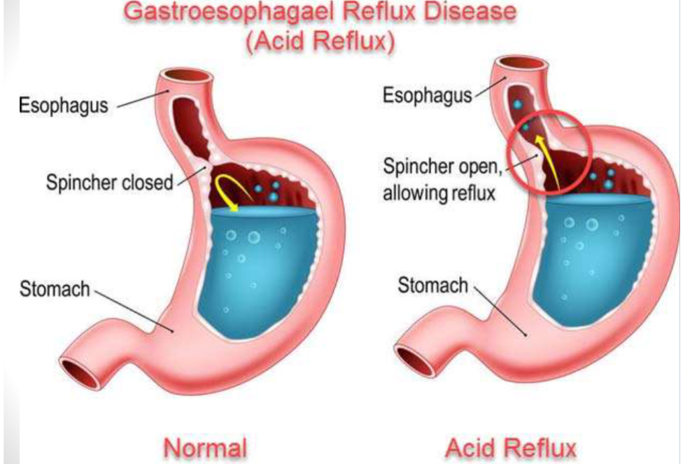 <p>Reflux of gastric content into the oesophagus</p><p>Symptoms:</p><ul><li><p>Gstric pain</p></li><li><p>Discomfort and wind</p></li><li><p>Nausea </p></li><li><p>Acidity (back of throat)</p></li><li><p>Abdominal pain</p></li></ul><p>Causes:</p><ul><li><p>Diet and lifestyle (overeating, drinking, obesity)</p></li><li><p>Pregnancy</p></li><li><p>Incompetence of oesophageal sphincter (hernia, drug induced)</p></li></ul><p></p>