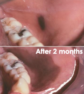 <p>benign ACQUIRED dark melanosis of mucosa</p>