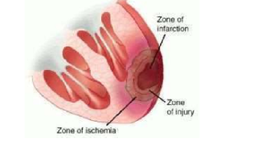 <p>zone of infarcting tissue where myocardial cell death is occurring due to continued ischemia </p><p>(releasing troponin)</p>