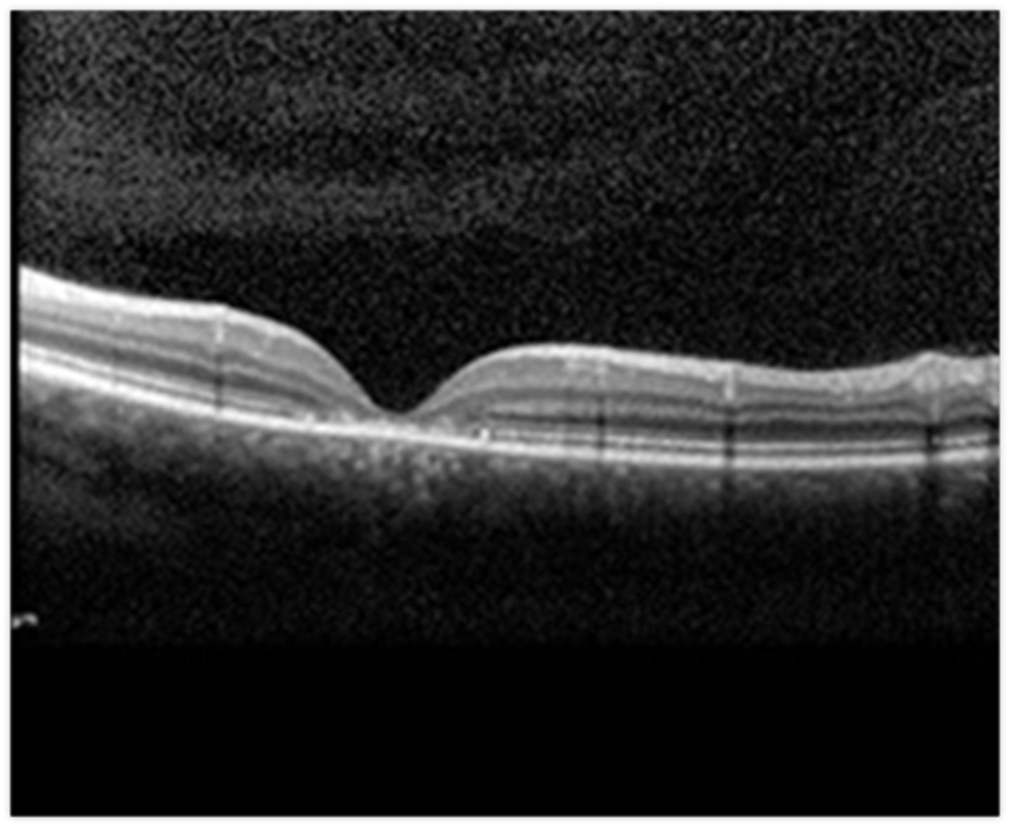 <p>OCT = PR atrophy</p><p>ERG and EOG = abnormal in later stages</p>