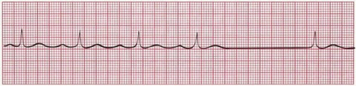 <p>Higher pacemaker (SA node) site fails</p><p>AV node produces beat (no P wave) to protect against asystole</p><p>switch off between SA and AV node producing beat (P and no P)</p>