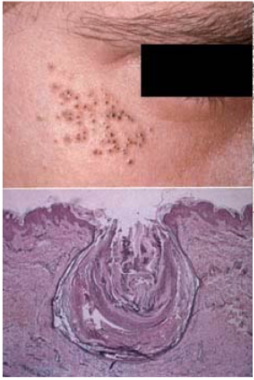 <p>blackhead acne (open comedone) </p><p>still able to produce melanin </p>