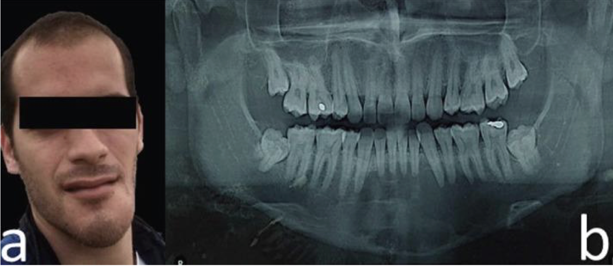 <p>A 20 year old boy presented with swelling of the lower face.</p><p>Provide DD</p>