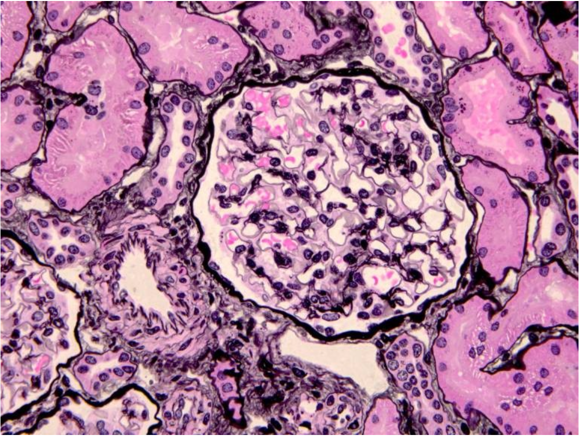 <p>This slide is stained with Jones Methenamine Silver (JMS) which stains basement membranes and matrix in black- also note the normal tubules and small artery (at 8 o’clock to glomerulus)</p>