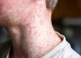 <ol><li><p>fever, high grade </p></li><li><p>tiredness</p></li><li><p>cough </p></li><li><p>red, raised, red bumps that start at hairline and move to arms and legs </p></li></ol><p>Cough, Coryza (runny nose), Conjuctivitis, Koplik spots </p>