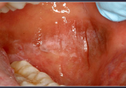<p>what coulld be the cause of this lesion </p>