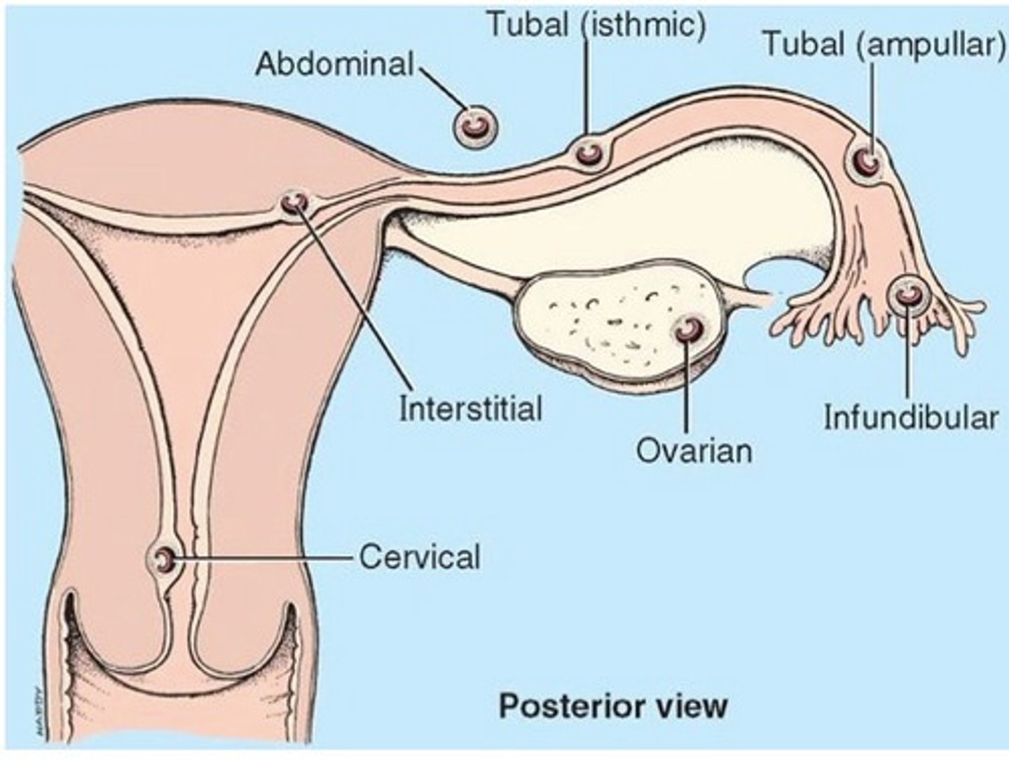 <p>-98.3% in fallopian tubes (especially ampulla)</p><p>-1.4% in abdomen</p><p>-0.15% in ovary</p><p>-0.15% on cervix</p>