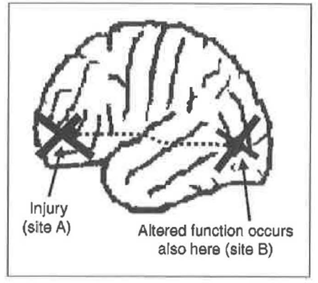 <p>- when a discrete, localized brain lesion disrupts functioning of spatially separate and structurally intact brain regions</p>