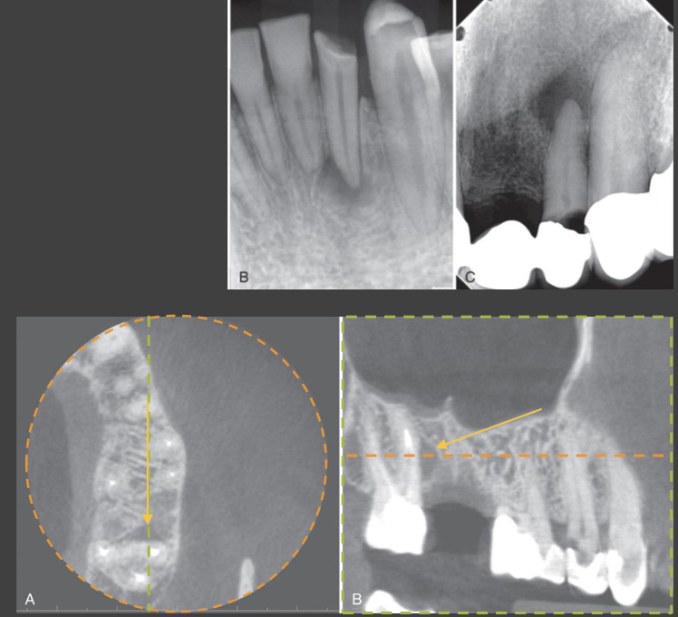 <ul><li><p>Around apex or adjacent to apical 1/3 of root</p></li><li><p>Epicenter adjacent to apex of involved tooth</p><ul><li><p>Migrates apically away from apex as lesion enlarges</p></li></ul></li><li><p>Less commonly adjacent to root surface at the</p><ul><li><p>exit of an accessory root canal</p></li><li><p>site of a perforation from root canal instrumentation</p></li><li><p>site of root fracture</p></li></ul></li></ul><p></p>