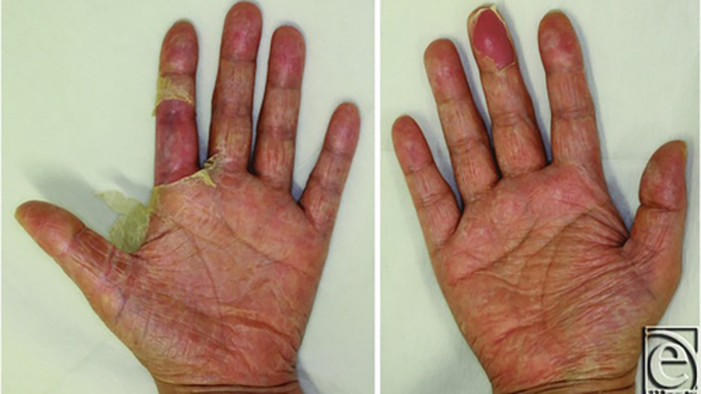 <p>- after childbirth/abortion/prolonged tampon use</p><p>- diffuse red rash, fever, disulpharimation of palms and soles</p>