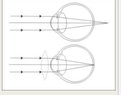 <p>hyperopia</p>