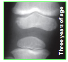 <p>Epiphyseal Plates</p>