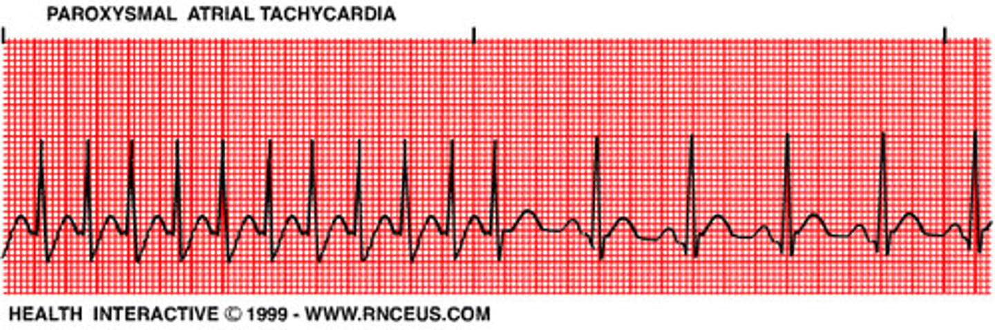 <p>SVT is a regular narrow-complex tachycardia usually 150 to 250 bpm.</p><p>P waves may be hidden in T waves, so PR is often hard to measure.</p><p>Stable SVT can be treated with oxygen, IV access, cardiac monitoring, and vagal maneuvers.</p><p>Adenosine is first-line if vagal maneuvers fail.</p><p>Adenosine administration is a 6 mg rapid IV push, then 12 mg if needed, while expecting a brief period of asystole.</p><p>Adenosine should not be used for irregular wide-complex tachycardias, because it can precipitate VF.</p>