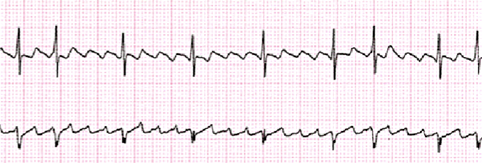<p>Rate: 120+ BPM<br>Rhythm: Irregular or Regular<br>P-Wave: Sawtooth<br>PR: None<br>QRS: 0.06-0.10</p>