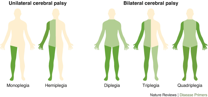 <ul><li><p><strong>quadriplegia</strong></p><ul><li><p>all 4 limbs</p></li></ul></li><li><p><strong>diplegia</strong></p><ul><li><p>all four limbs; LEs more severely affected than UEs</p></li></ul></li><li><p><strong>hemiplegia</strong></p><ul><li><p>one side affected; UE usually more involved</p></li></ul></li><li><p><strong>triplegia</strong></p><ul><li><p>three limbs; usually UEs + LE</p></li></ul></li><li><p><strong>monoplegia</strong></p><ul><li><p>only one limb; usually UE</p></li></ul></li></ul><p></p>