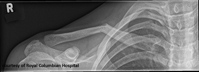 <p>Greenstick fracture.</p>