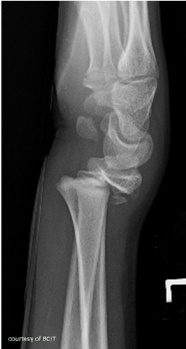 <p>what fracture type is this</p>
