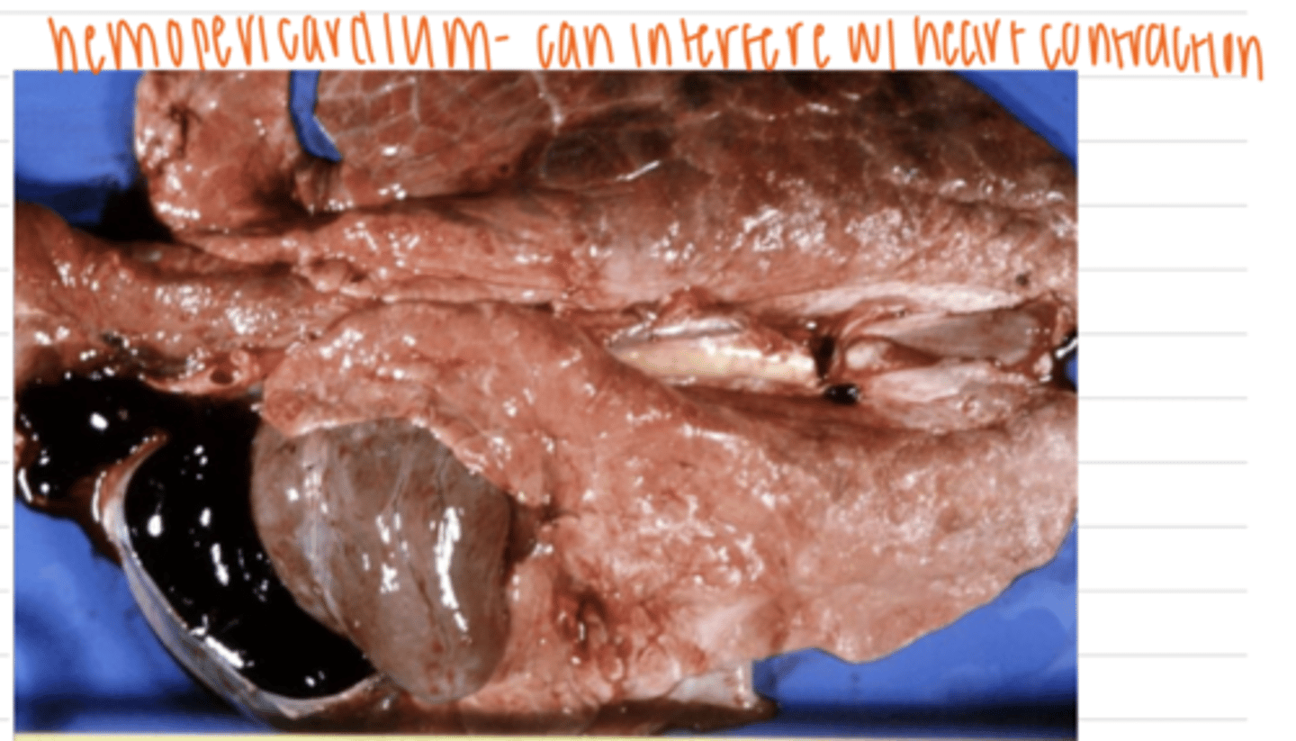 <p>hemopericardium</p>