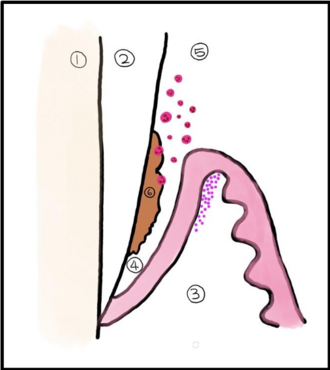 <p>Tandvleesholte/pocket</p>