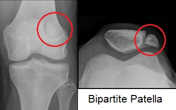 <p>How do you distinguish a bipartite patella from a fracture?</p>