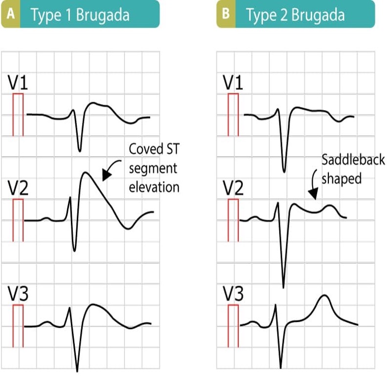 <p>type 1- Coved shape: convex shaped ST elevation in V1-V3</p><p>type 2- carousel horses sign: saddle shape type ST elevation in V1-V3</p>