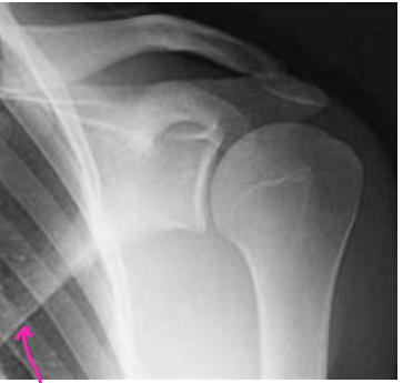 <p><strong>Grashey View</strong></p><p>-Not part of the standard shoulder films, more of an ortho thing</p><p>-Called the “true AP” view </p><p>-Provides a better view of the __ joint</p><p>-Can be taken with the humerus in ________ or _________ rotation</p>