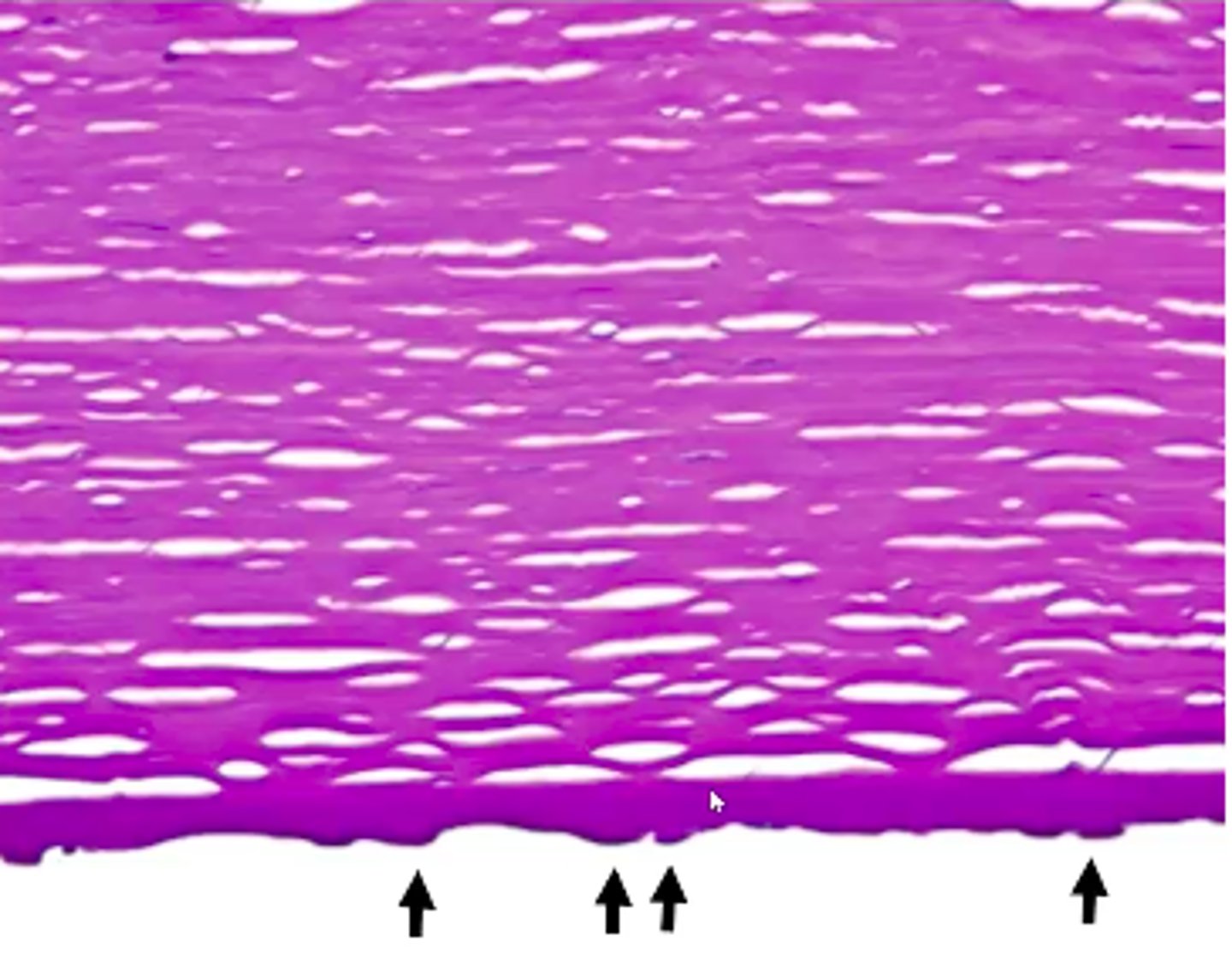 <p>Information for Condition:</p><p>Common endothelial dysfunction in Cornea - endothelium produces deposits (guttae) on Descemet membrane --&gt; stromal edema --&gt; subepithelial bullae on cornea</p>