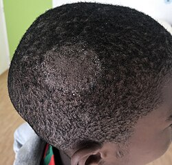 <p>PP: fungal infection of scalp</p><p>E: dermatophytes</p><p>CM: dry scaling<br>moth-eaten hair loss<br>inflamed mass/abscess (kerion)→untx→permanent scarring/baldness</p><p>DX: bx culture</p><p>TX:<br>NP: throw out hairbrush<br>adjunctive therapy</p><p>MX: ketoconazole shampoo<br>selenium sulfide shampoo<br>PO griseofulvin x 6 weeks-6 months</p><p>P: swollen lymph glands at sides/back of neck</p>