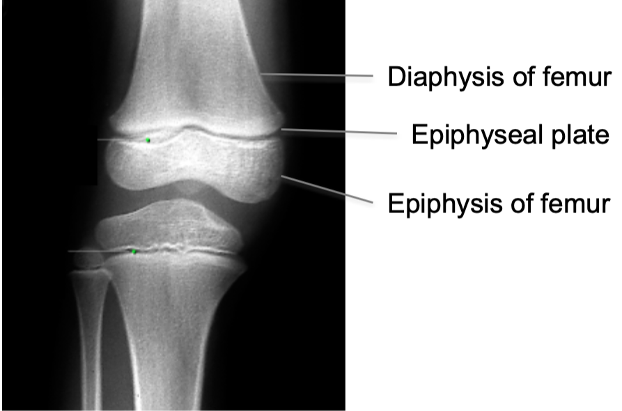 1. Cartilage is gradually replaced by bone tissue on both sides of 
the epiphyseal plate (primary and secondary center of ossification)
2. Centers of ossification meet at the epiphyseal plate 
3. Growth stops