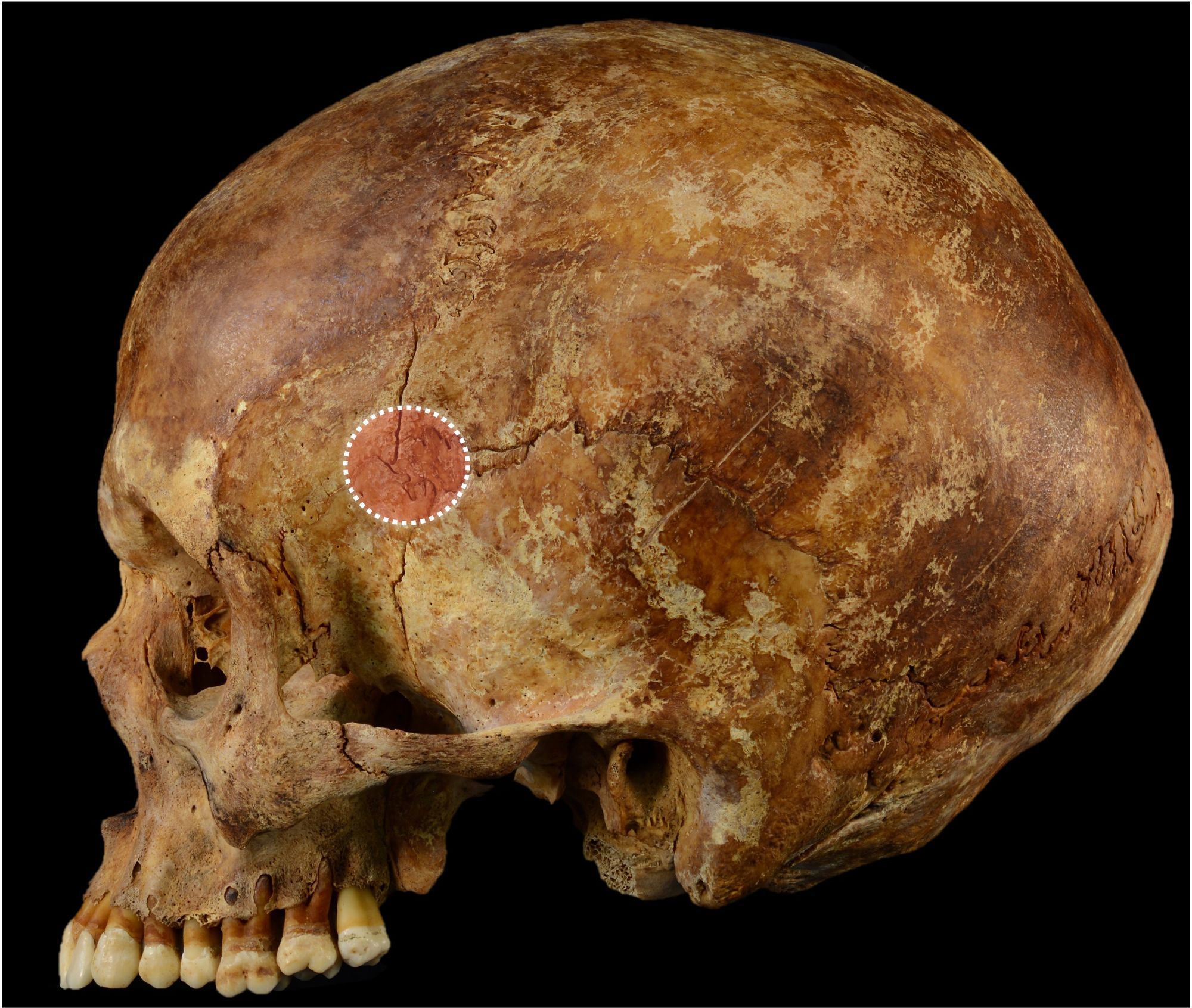 <p>Region where frontal, temporal, parietal, and sphenoid meet on the side of the vault</p>