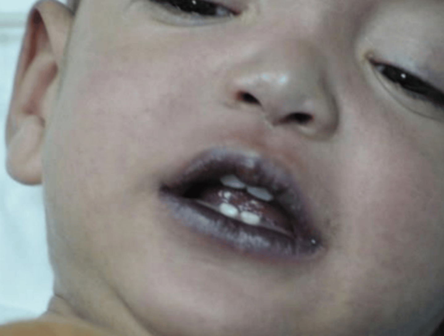 <p>Cyanosis of the mucous membranes such as the tongue, conjunctiva, lips, and skin.</p>