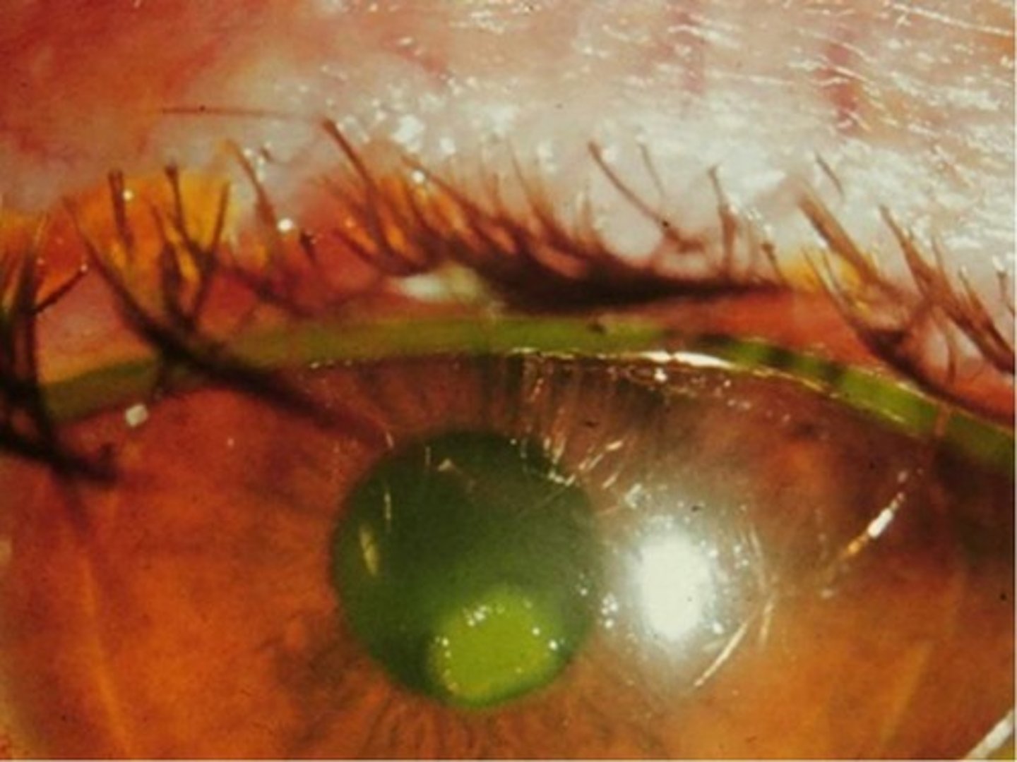 <p>disruption of the superficial epithelium of the cornea</p><p>- presents clear so you need a fluorescence dye to see it</p><p>-does not change shape of cornea</p>
