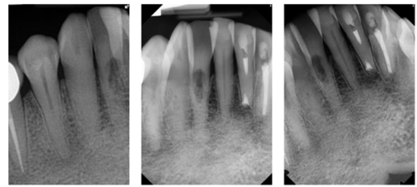 <p>Patient presents with these radiographic findings, what type of resorption? </p><p>- Incidental finding</p><p>- Radiolucency around cervical aspect of tooth</p><p>- Portal of entry present in cervical region</p><p>- Chamber/canal outline is visible </p>