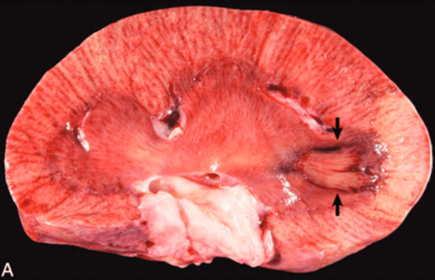 <p>What type of necrosis is being shown in this image?</p>