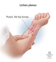 <p>PP: inflammatory disease of skin+mucous membranes+hair follicles<br>mucous membranes→malignancy risk</p><p>E: T-cell mediated immune reaction<br>acute or chronic<br>Hepatitis C infection</p><p>CM: white lines→whickam striae</p><p>DX: 4 P’s<br>purple<br>polygonal<br>pruritic<br>papules</p><p>TX:<br>NP:<br>self-limiting x 8-12 months<br>phototherapy</p><p>MX:<br>superpotent topical steroids<br>superpotent intralesional steroids</p><p>mouth→benzocaine</p><p>systemic: isotretinoin<br>acitretin<br>cyclosporines</p>