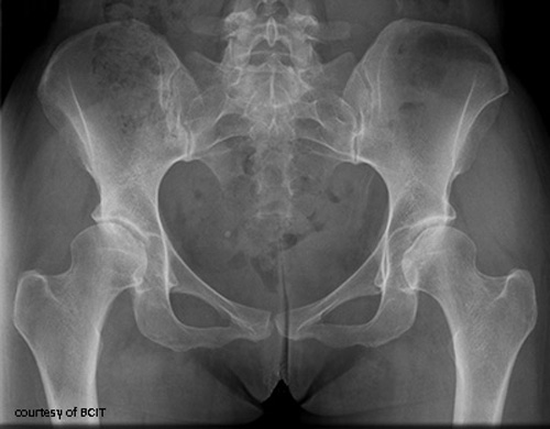 <p>What anatomical features make the pelvis structurally stable?</p>
