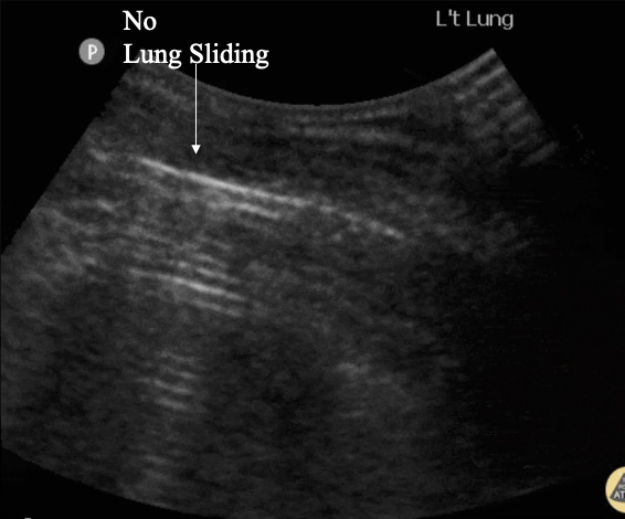 <p>What is the Lung point sign?</p>