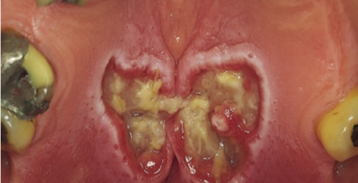 <p>How long does necrotizing sialometaplasia take to resolve?</p>