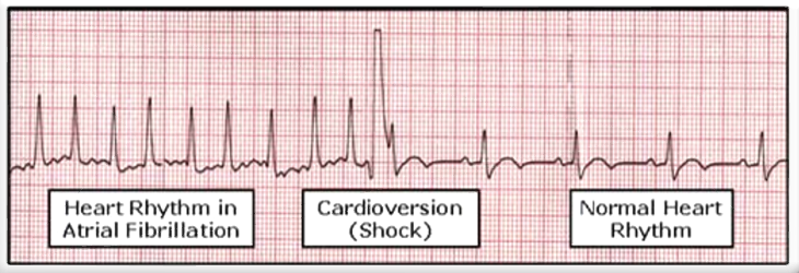 <ul><li><p>Shock delivered on the R wave at ventricular depolarization. </p></li></ul><p></p>