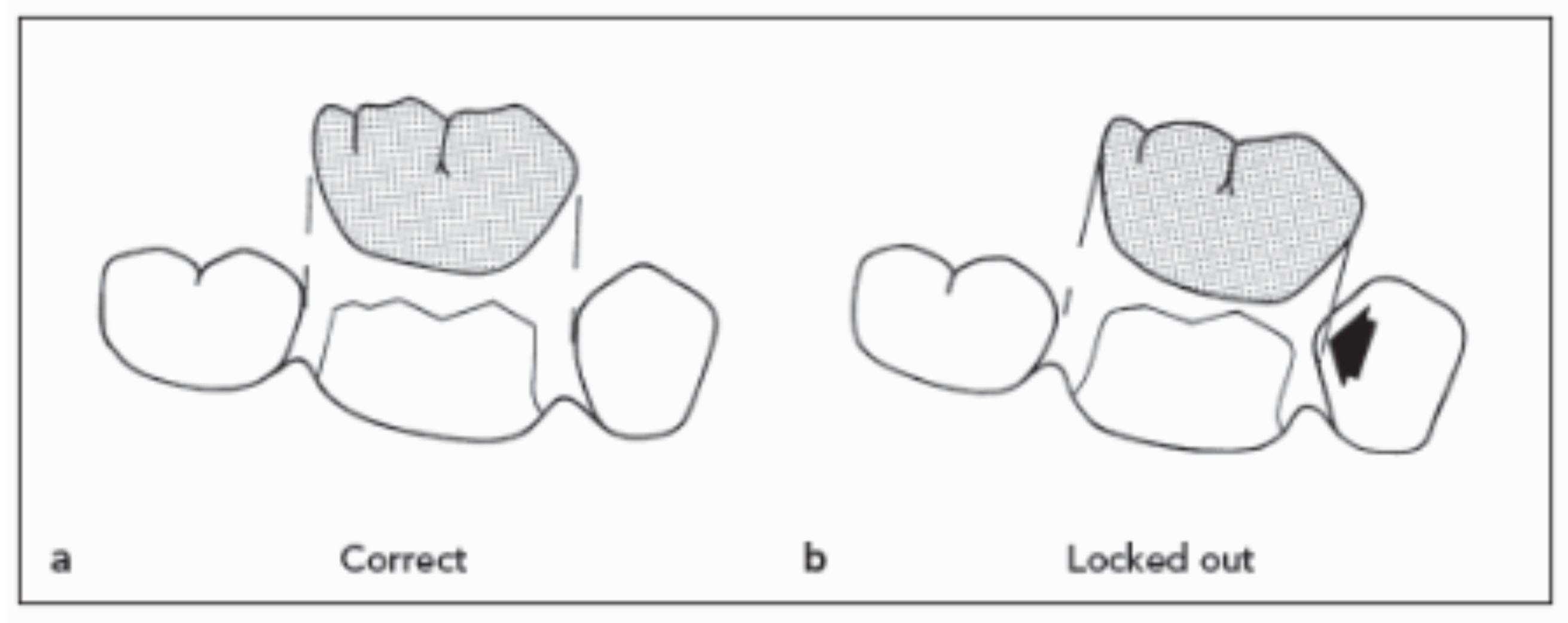 <p>parallel to the adjacent proximal contacts </p>