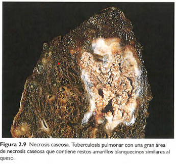 <p>-En focos de infección tuberculosa </p><p>-Tiene aspecto friable y color blanco. (Parecido a queso)</p><p>-Se almacenan células fragmentadas o lisadas y restos granulares amorfos delimitados por un margen inflamatorio definido (granuloma) </p>