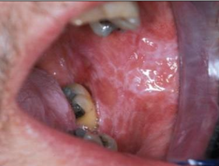 <p>What is the clinical presentation of lichen planus intraorally?</p>